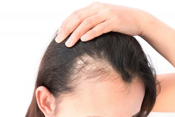 19 maneiras surpreendentes de prevenir a queda de cabelo nas mulheres