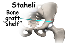 orthopedic chirugus: OSTEOTOMIES AROUND HIP