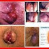 Keluar Darah Segar dan Lendir dari Mulut Anus, Penyakit Apa thumbnail