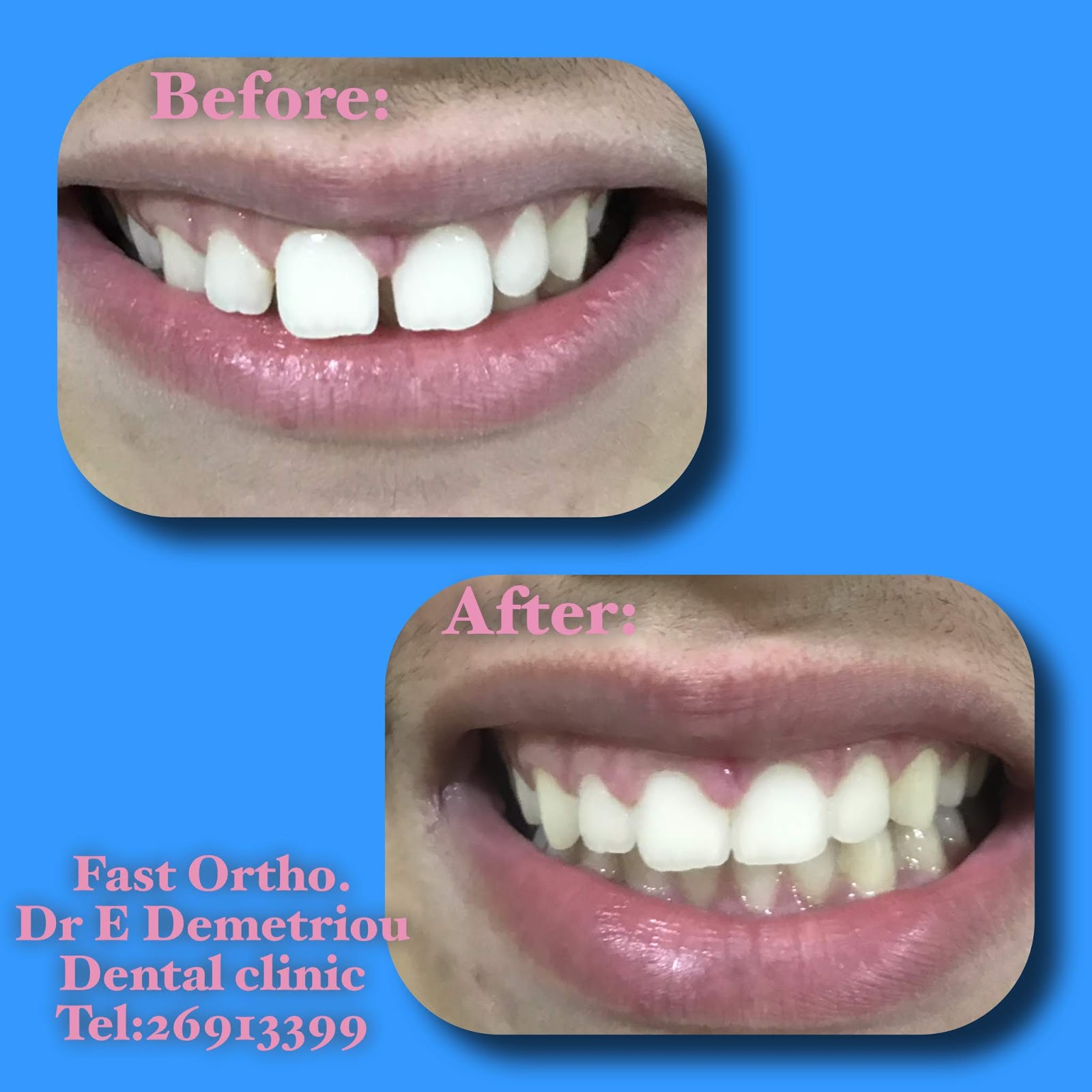 Paphos Dentist, Dr Elena Demetriou Examples of our work