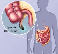 Obat Usus Buntu