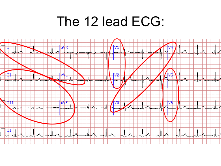Смещение st вверх v4 v5. 12 lead ecg. смещение st вверх. смещение st вверх в v3v4. смещение st вниз v1 что это значит на экг.