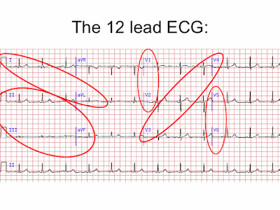 ECG ( Electocardiogram ) 12 leads ECG - Med Club 12 lead diagram septal 