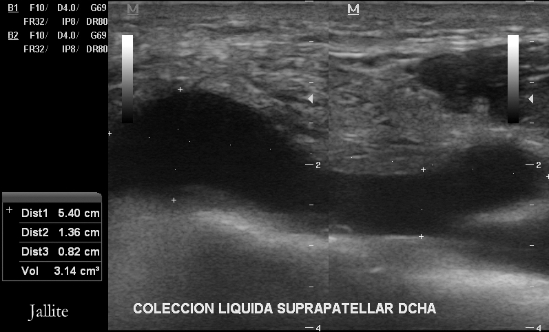 Diario de un Medico II: Artritis Rodilla
