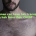 Now men can have hair transplants using hair from their CHEST