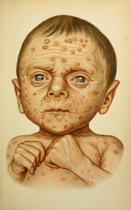 A haunting portrait of a 4 week old baby with hereditary syphilis who died just 24 hours after being admitted to hospital in 1897