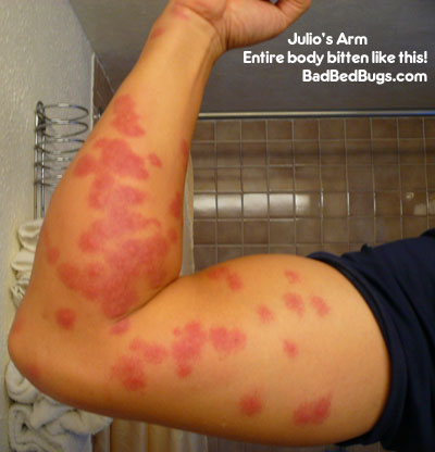 Insect Bites Identification, Treatment & Home Remedies