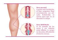 https://steviaven.blogspot.com/2017/10/consejos-calmar-dolor-varices.html https://steviaven.blogspot.com/2017/10/consejos-calmar-dolor-varices.html