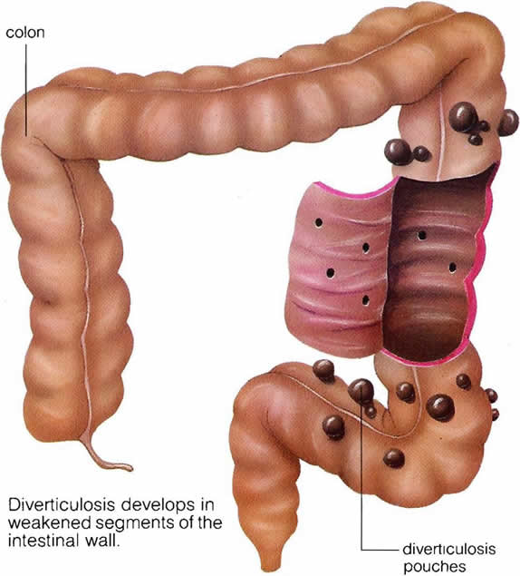 Doctor Gastro: Consejos Prácticos: Diverticulosis no es igual que ...