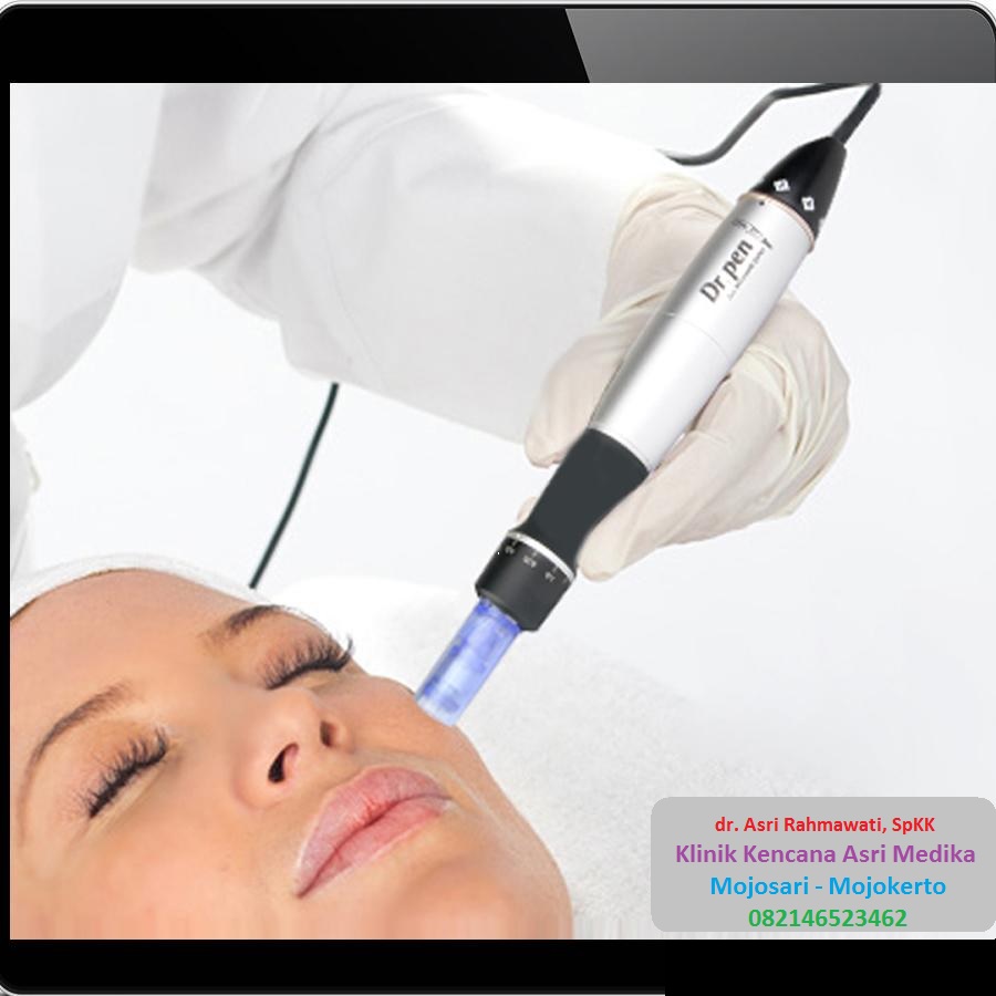 Дермапен мезотерапия. Фракционная мезотерапия для лица. Микронидлинг дермапен. Фракционная микроигольчатая терапия. Фракционная микроигольчатая мезотерапия.