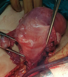 TAH and BSO for case with multiple uterine fibroid