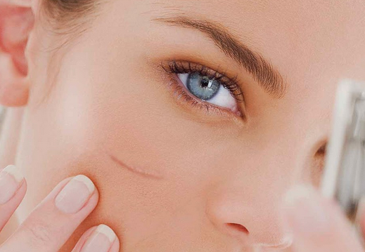 Obat Penghilang Bekas Luka Jahitan di Wajah - Semua Tentang Penyakit Kulit