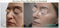Revision Nose Tip Plasty in Istanbul