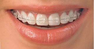 blanqueamiento dental, carillas estéticas, carillas de porcelana, sonrisa perfecta, snowdent, clínica dental, 