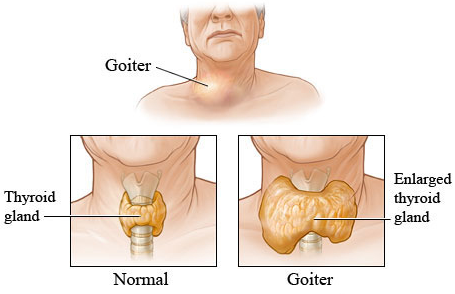 Goitre, symptoms and causes | Ronocko Health