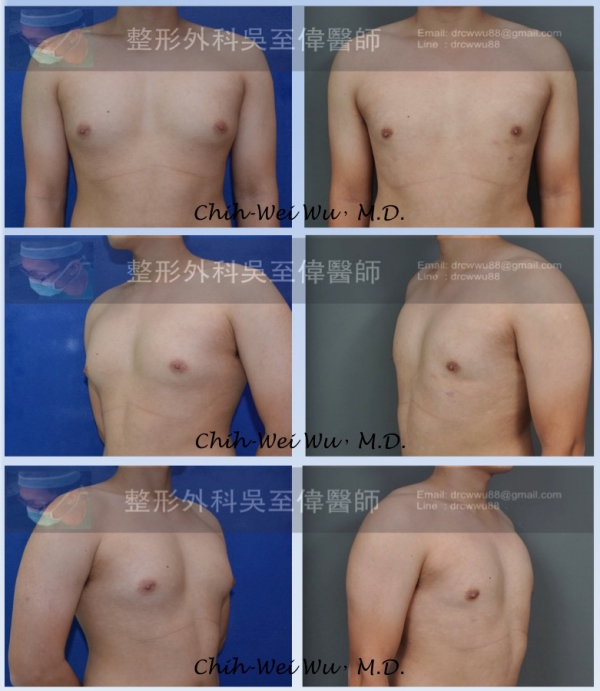 男性女乳案例 男性女乳案例
