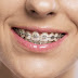 Niềng răng mắc cài kim loại tự buộc là gì và có ưu điểm gì?