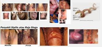 Foto Nama Obat Sipilis Untuk Wanita