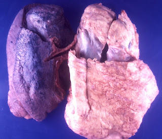 Pleural Plaques Pleural Plaques