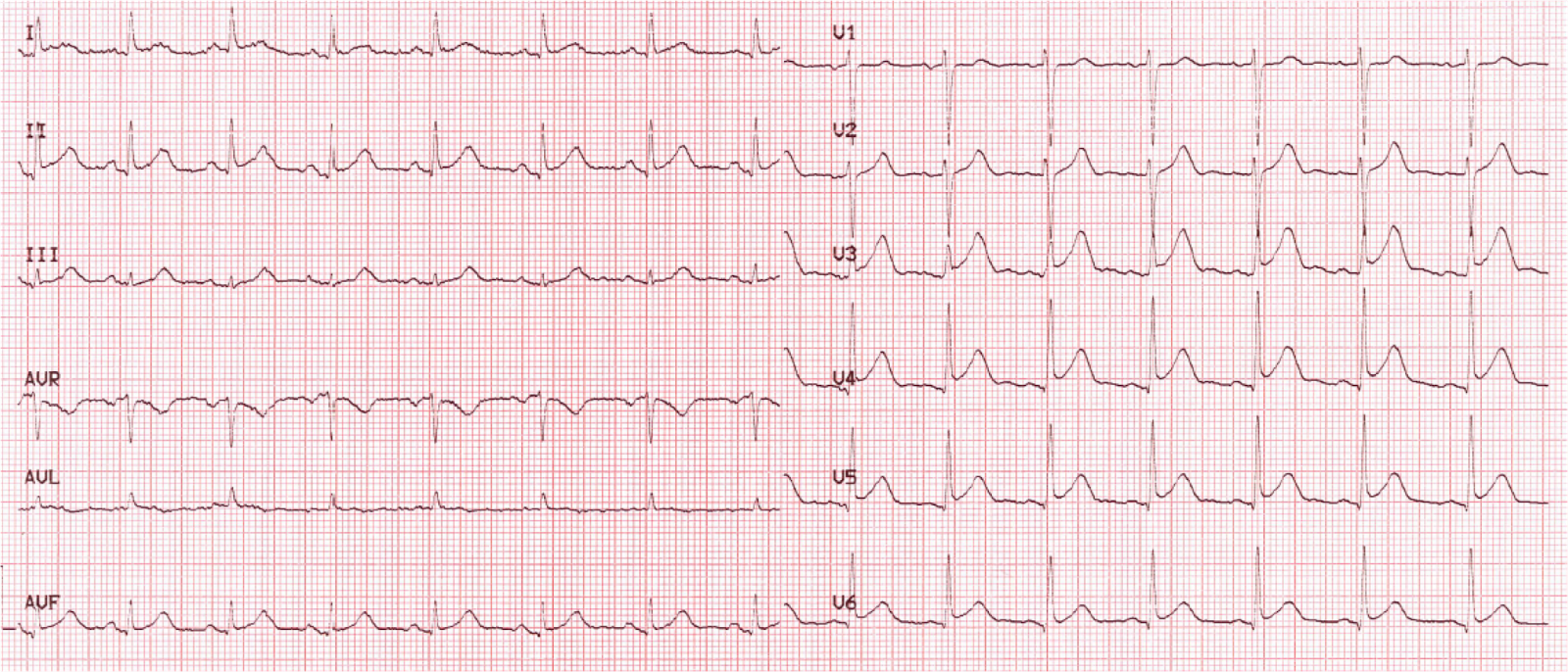 Qrs на экг что это