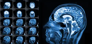 MRi of brain Neurological Physiotherapy