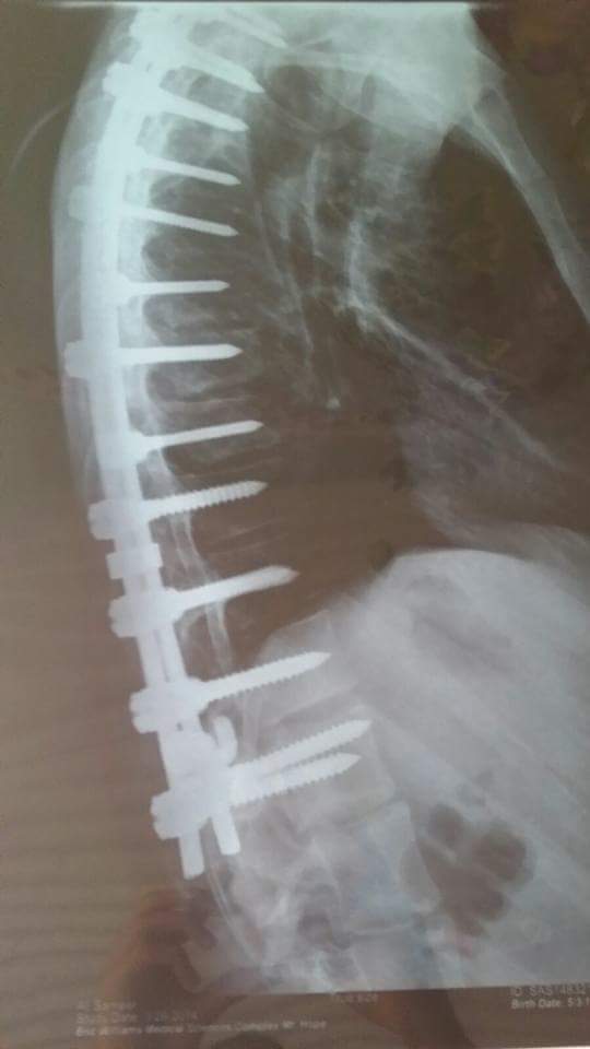 Obasa's blog STOP! THE EFFECT OF CARRYING HEAVY BAG ON CHILDREN'S BACK