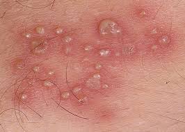 Foto Cara Ampuh dan aman Mengobati Penyakit Cacar Api atau Herpes