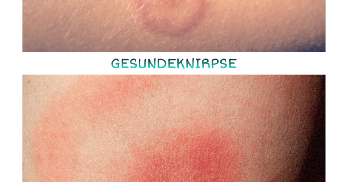gesunde knirpse Borelliose