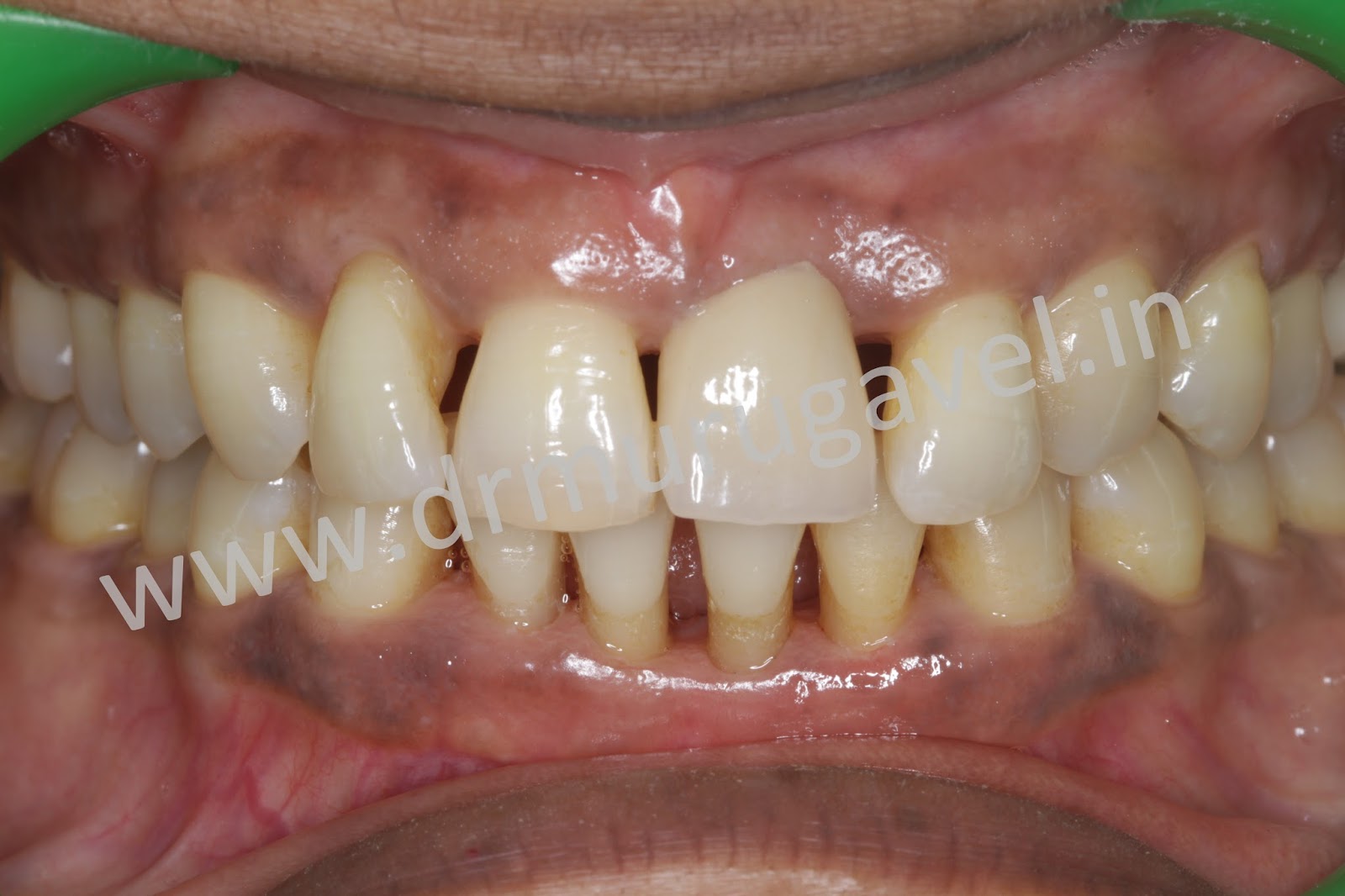 Front teeth esthetic replacement with dental implantswithout bone grafting surgeries!!