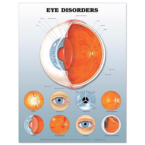 chulanga vision EYE DISORDERS AND DISEASES