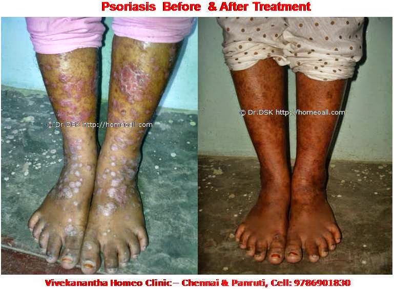  Homeopathy skin doctor clinic velachery chennai tamil nadu, ஓமியோபதி ஸ்கின் டாக்டர் சென்னை, வேளச்சேரி 