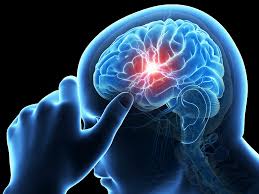Sakit stroke hemoragik apa bisa sembuh?, Mengatasi Penyakit Stroke Sebelah Kanan, obat herbal ampuh stroke ringan sebelah kiri