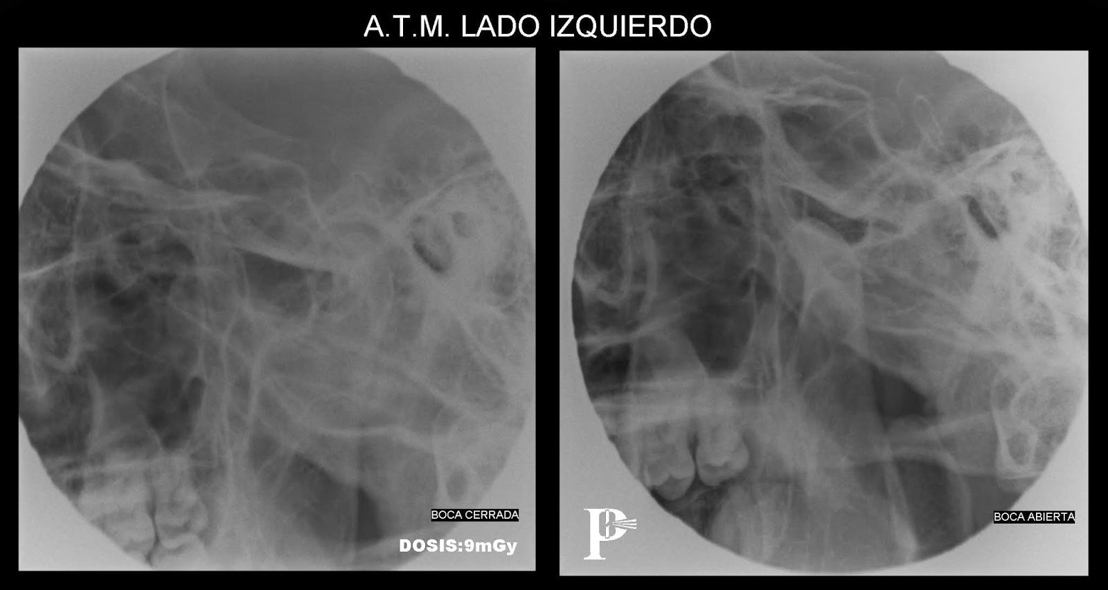 cementoblastoma benigno etiologia diabetes