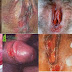 Tanda-tanda sariawan pada vagina