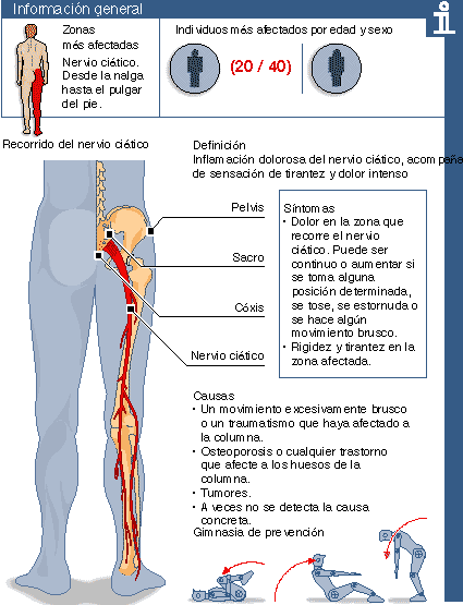 porque causas se inflama el nervio ciatico porque causas se inflama el nervio ciatico