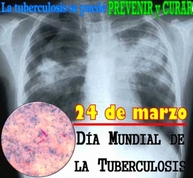 Día Mundial de lucha contra la Tuberculosis Imagen de una radiografía por el Día Mundial de lucha contra la tuberculosis