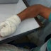 Barreiras: homem alcooliado decepa dedos de comerciante durante briga no bairro São Francisco