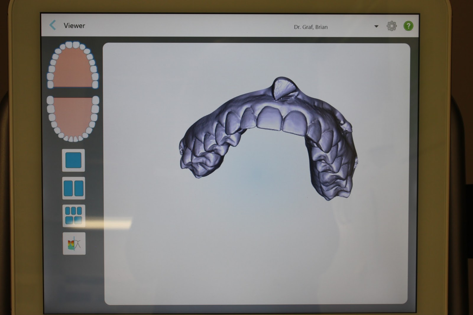 Graf Orthodontics No more gagging, messy impressions!
