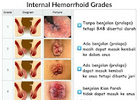 Obat Menyembuhkan BAB Keluar Darah Yang Ampuh Obat Menyembuhkan BAB Keluar Darah Yang Ampuh