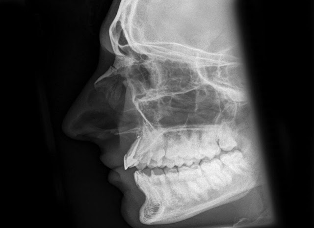 Broken nose | Nasal Bone Fracture aetiology and management