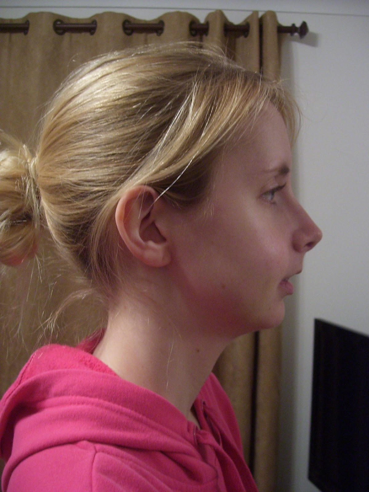 My Jaw Surgery Story Day 18