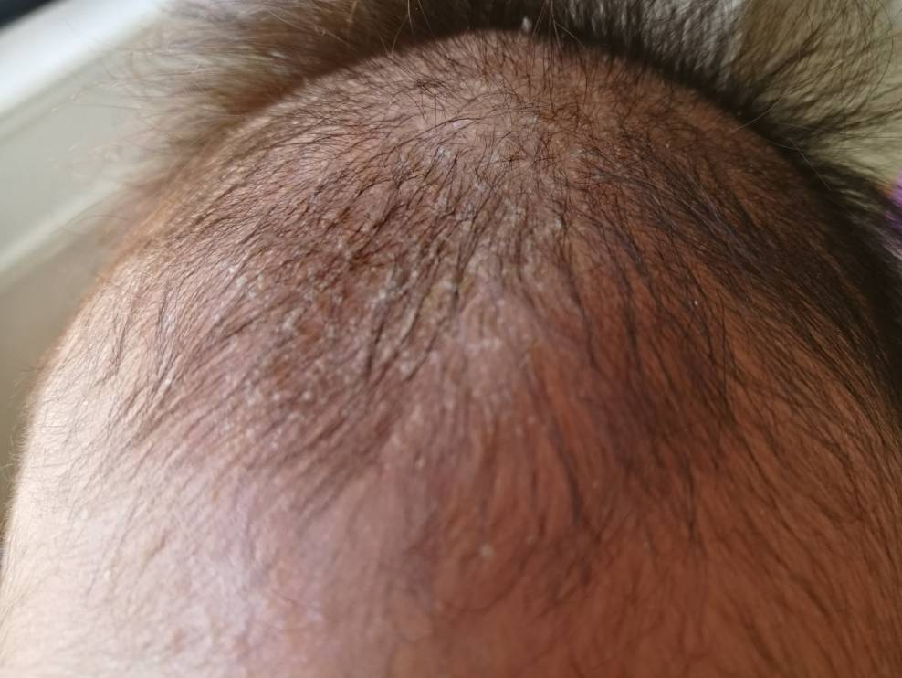 How To Treat Cradle Cap Michelle Dolphin