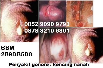 Pengobatan Kencing Nanah Dengan Antibiotik Antibakteri Herbal Pengobatan Kencing Nanah Dengan Antibiotik Antibakteri Herbal