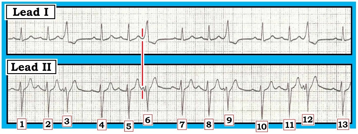 ECG Interpretation: ECG Interpretation Review #67 (PAC – PVC – 12 Leads ...