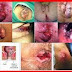 Obat Wasir Bengkak Resep Dokter thumbnail