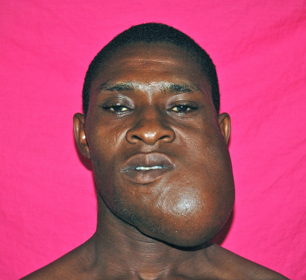 Earthwide Surgical Foundation AMELOBLASTOMA REDUX