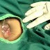 Salep Manjur Benjolan di Sekitar Anus thumbnail