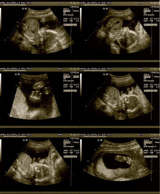 What To Expect At 20 Week Anatomy Scan