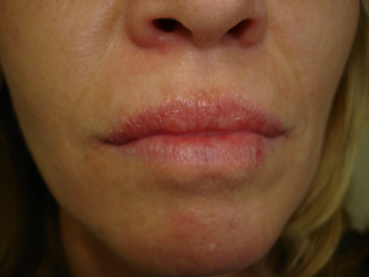 lip eczema