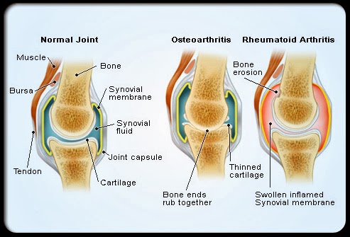 Analitica para artritis reumatoide